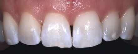 Close-up of white teeth and pink gums in a smile