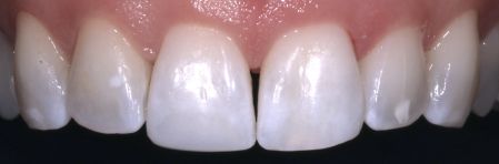 Close-up of upper front teeth with white, slightly uneven edges against a dark background