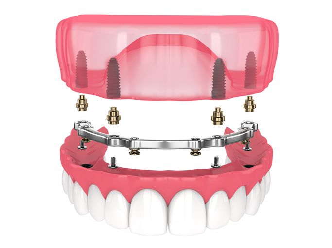 Dentures with a metal implant bar and pink gum base above white teeth