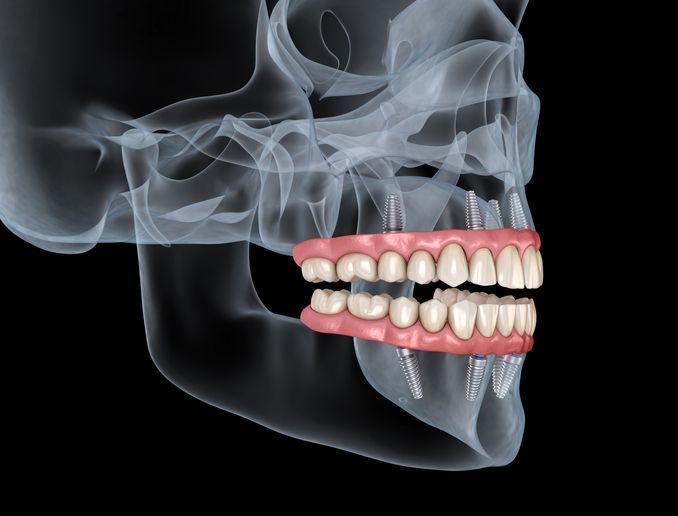 Side-view X-ray of a skull with realistic upper and lower dentures displayed over the teeth