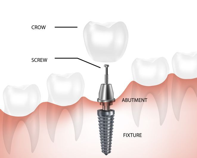 Dental implant diagram showing crown, screw, abutment, and fixture in a tooth gum cross-section