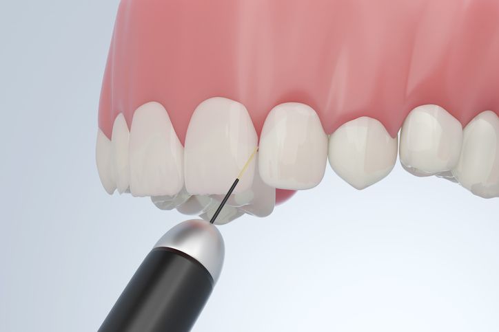 Dental tool pointing at lower front teeth in a close-up of a mouth model