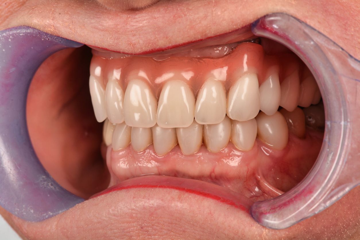 Close-up of teeth and gums with a cheek retractor in place during a dental exam