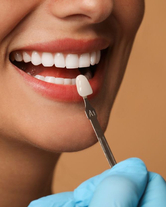 Close-up of a smiling mouth as a gloved hand applies white dental material to a front tooth.