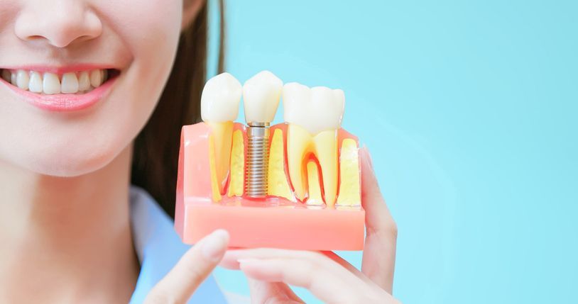 Smiling woman holding a dental implant model with teeth and gums on a blue background