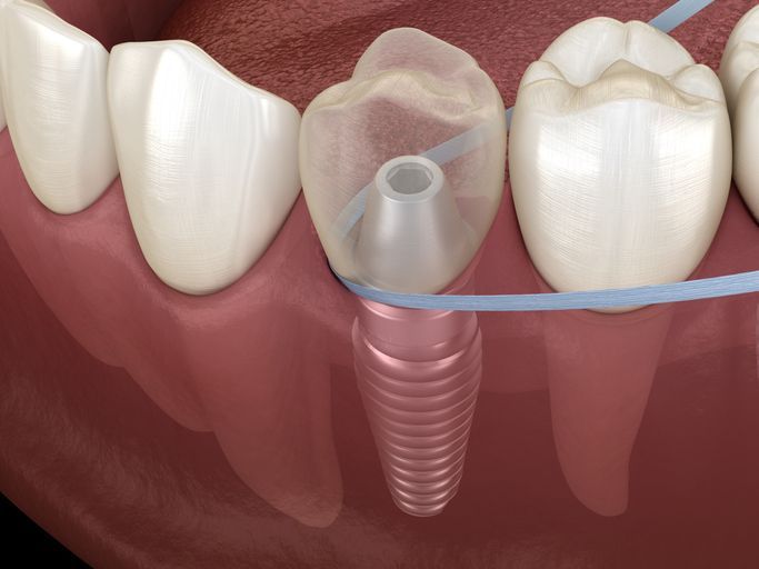 Dental implant illustration showing a screw implant under a molar with adjacent teeth and blue alignment line