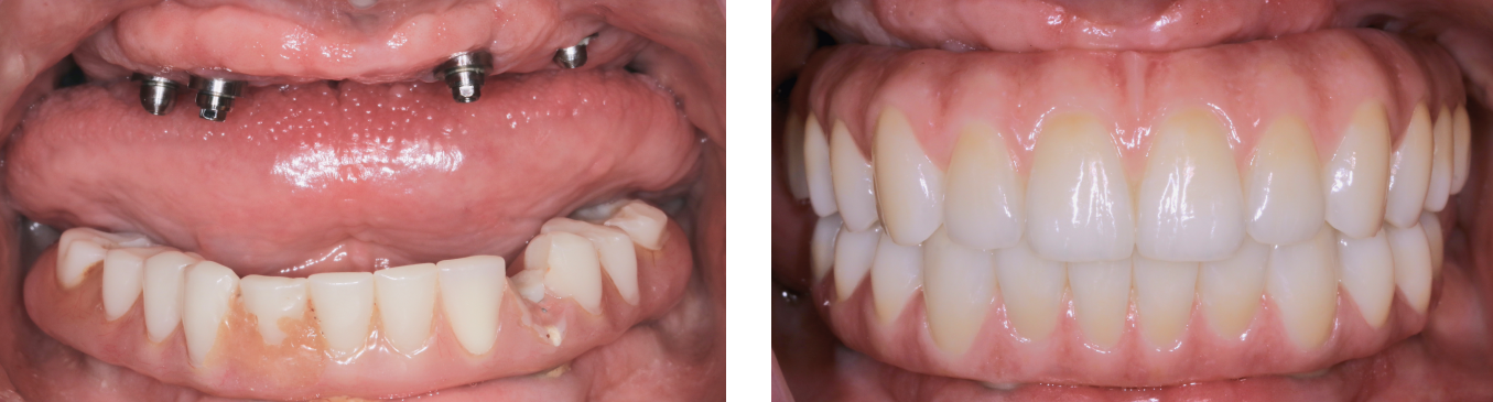 Side-by-side close-up of teeth with gaps on the left and a full, aligned smile on the right