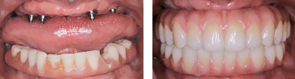 Side-by-side close-up of teeth with gaps on the left and a full, aligned smile on the right