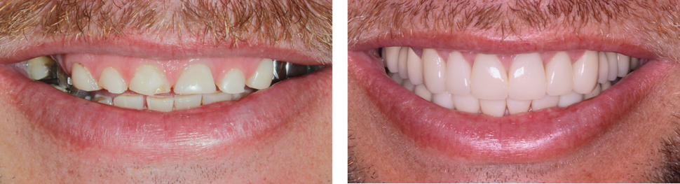 Close-up of a mouth with crooked, discolored teeth beside a wider, brighter smile