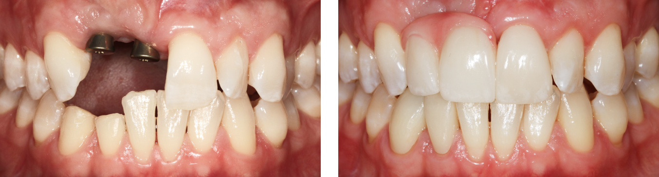 Close-up of teeth before and after treatment, showing a dark gap filled and teeth aligned better