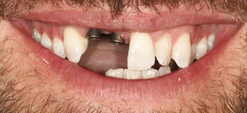 Close-up of a smiling mouth with several missing front teeth and visible dental work
