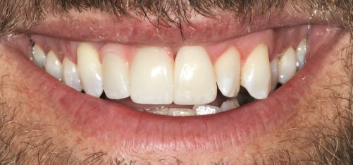 Close-up of a smiling mouth showing white teeth and pink lips with a bit of stubble.