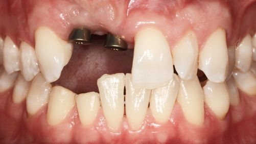 Close-up of a mouth with missing upper front teeth and visible metal dental implants.