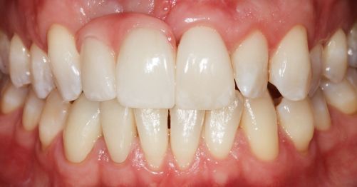 Close-up of a person’s teeth with visible yellowing and crowding