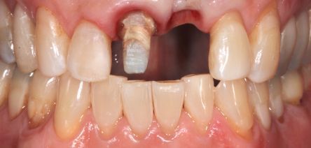 Close-up of teeth with a single front tooth prepared for a dental crown