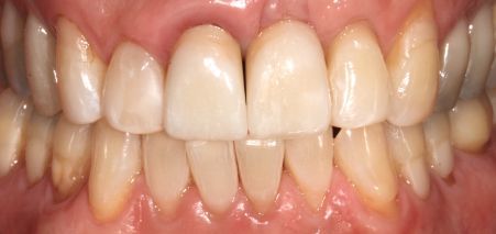 Close-up of teeth with a visible gap between the upper front teeth