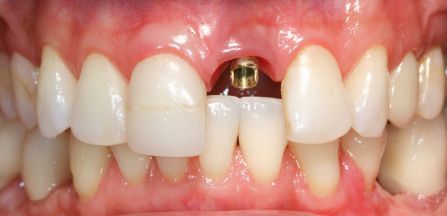 Close-up of upper front teeth with a gold dental implant post exposed in the center gums