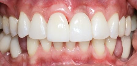 Close-up of white front teeth with pink gums and a slight gap between lower teeth