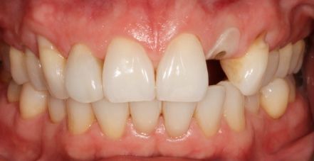 Close-up of teeth with a large gap between the upper front teeth and mild crowding below