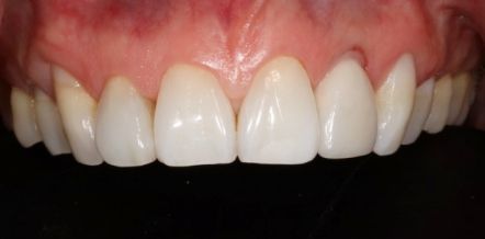 Close-up of a smiling mouth showing straight white teeth and pink gums