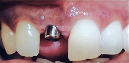 Close-up of front teeth with a dental implant abutment visible between the incisors.