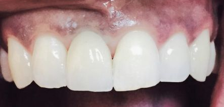 Close-up of upper front teeth with a missing tooth and visible pink gums