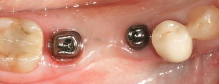 Close-up of two metal dental implants and a white tooth on pink gum tissue.