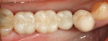 Close-up of lower molars and a cream-colored dental crown in a mouth
