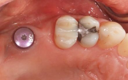 Close-up of a dental implant with a purple healing cap beside natural teeth and gum tissue