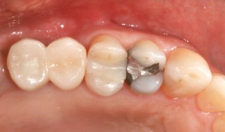 Close-up of upper molars with one silver dental filling and slight gum redness