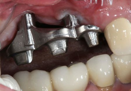Close-up of dental bridge framework over gums, with adjacent white teeth visible