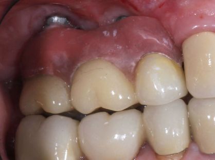 Close-up of upper and lower teeth with a reddish gum lesion above the back molars.