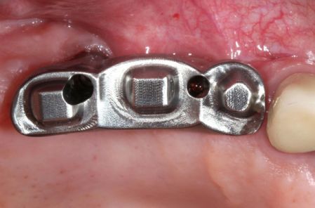 Close-up of a metal dental implant abutment in a mouth, next to a tooth.