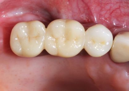 Close-up of molars with a small white dental crown beside natural teeth.