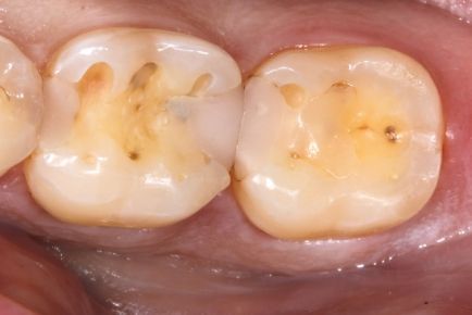 Close-up of two molars with brown cavities and discoloration on chewing surfaces