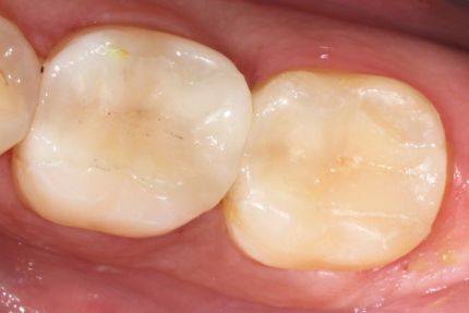 Close-up of two white molars with a small yellow-brown stain near the gumline.