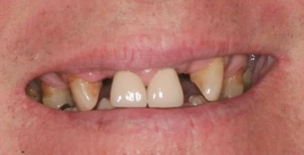 Close-up of a mouth with several damaged and missing teeth, showing a dental gap