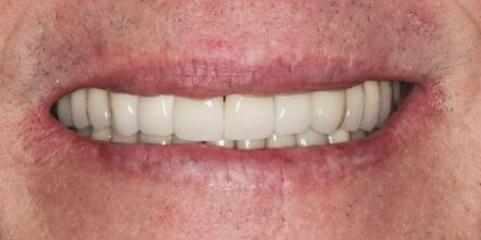 Close-up of a smiling mouth showing bright white teeth and pink lips