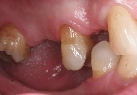 Close-up of teeth with a dark, swollen gum area and yellowed plaque buildup