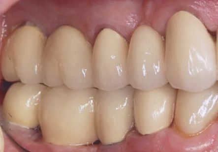 Close-up of upper and lower teeth showing a natural bite with slightly uneven alignment