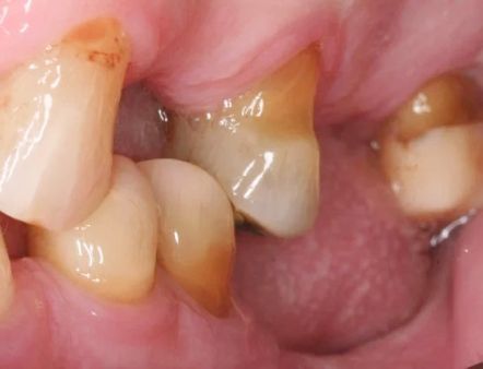 Close-up of a mouth with teeth and gums, showing dental plaque and discoloration