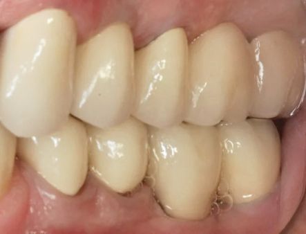 Close-up of teeth with off-white crowns and visible gum line