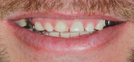 Close-up of a smiling mouth with visible teeth and pink lips
