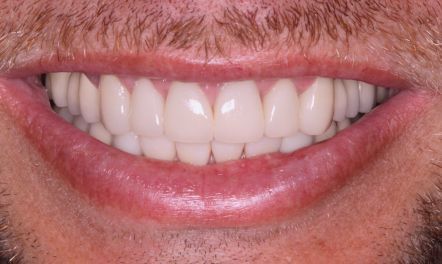 Close-up of a smiling mouth with white teeth and light facial hair