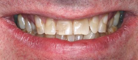Close-up of a smiling mouth showing yellowed teeth and pink lips