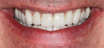 Close-up of a smiling mouth showing white teeth and pink lips