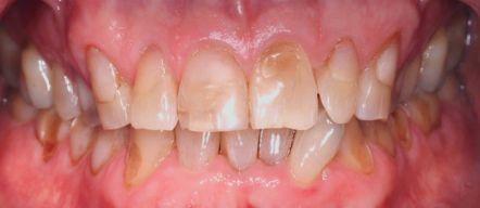 Close-up of teeth with visible crowding and misalignment, showing lower front teeth behind upper teeth
