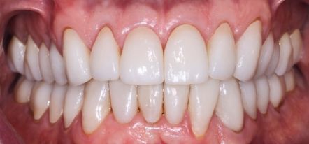 Close-up of a smiling mouth showing bright white teeth and pink gums