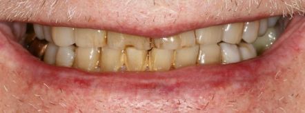 Close-up of a smiling mouth with stained yellow teeth and lips