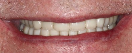 Close-up of a smiling mouth with white teeth and pink lips